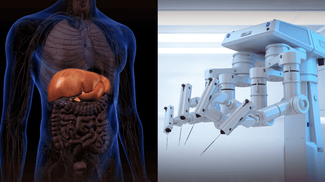 ChatGPT asiste en su primera operación robótica y realiza extirpación de vesícula exitosamente. ChatGPT asiste en su primera operación robótica y realiza extirpación de vesícula exitosamente.