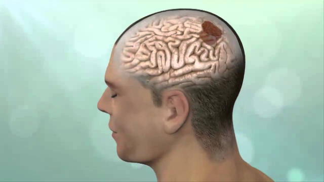 Sintomas de tumores cerebrales aparecen de manera abrupta