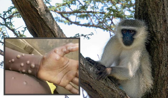  La viruela del mono se caracteriza por tener un genoma de ADN.   