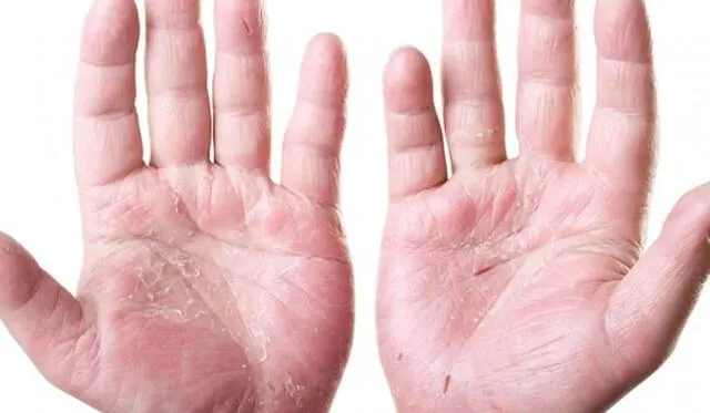 ¿Por qué se me pelan las manos, y qué hacer para evitarlo?