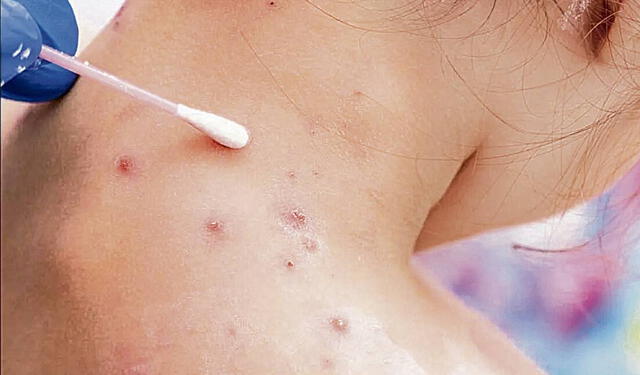  Viruela del mono casos confirmados en Perú ascienden a 64, según Minsa   