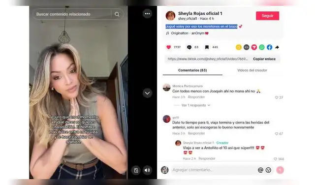 Sheyla Rojas explica por qué tiene moretones en brazos. Sheyla Rojas explica por qué tiene moretones en brazos.