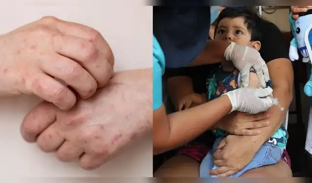 Brote de sarampión no cede: amplían emergencia sanitaria y refuerzan vacunación en el país. Foto: Composición EP.