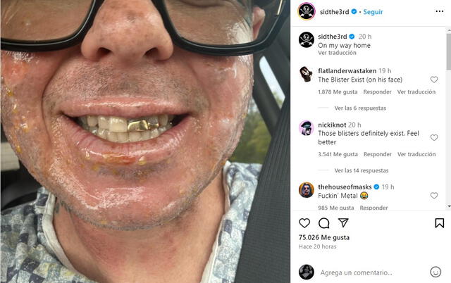 Sid Wilson, DJ de Slipknot, sufrió quemaduras en su rostro y brazos y revela su estado actual en sus redes.