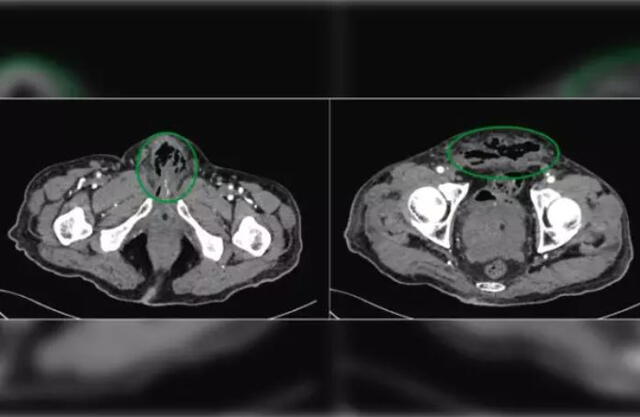  Imágenes de tomografía computarizada que muestran el agrandamiento de la próstata de un hombre con múltiples abscesos | Urology Case Reports    