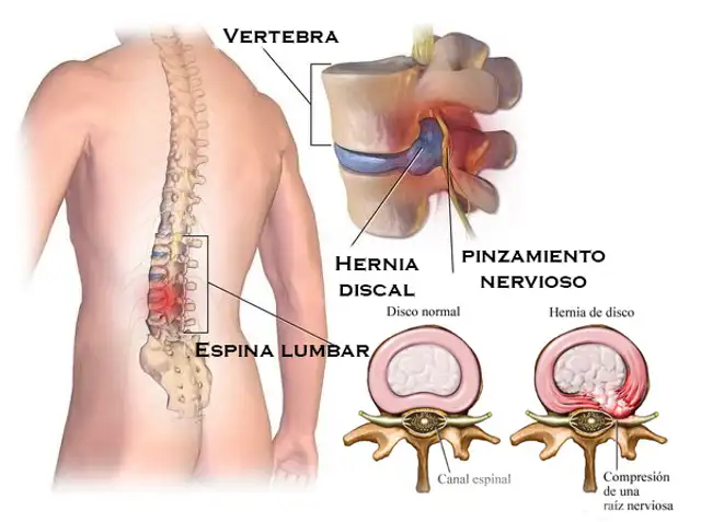  Dolor lumbar. Crédito: Salud Bienestar y Vida Ortopedia.   