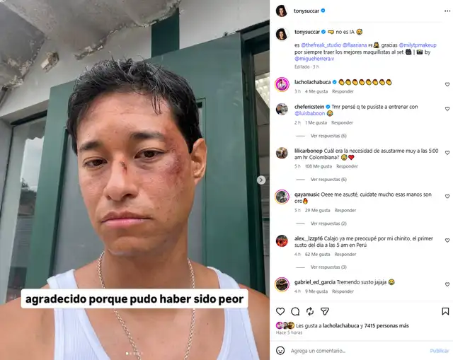 Tony Succar preocupa al aparecer con moretones en todo el rostro y revela su estado