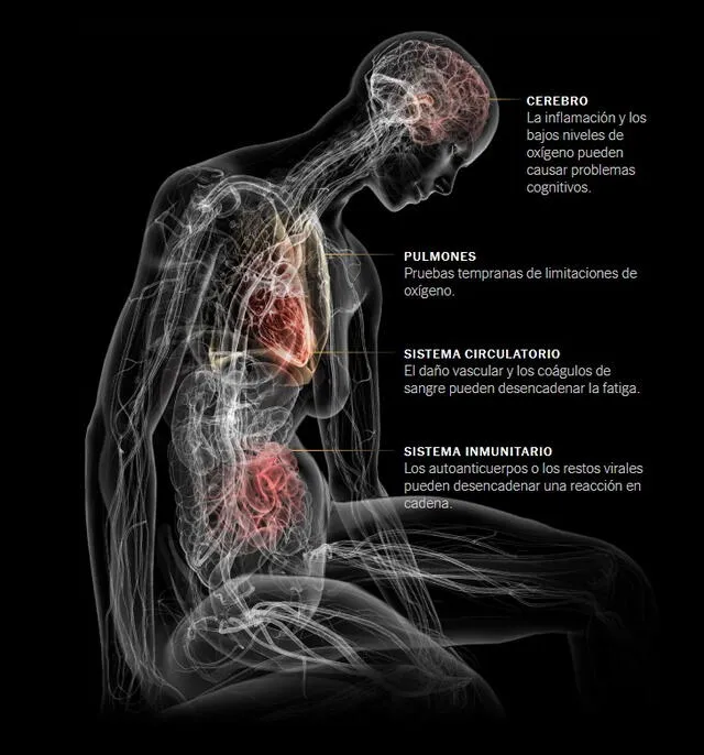  Covid -19 persistente genera agotamiento en el cuerpo. Crédito: New York Times. 