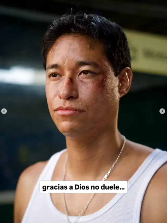 Tony Succar preocupa al aparecer con moretones en todo el rostro y revela su estado