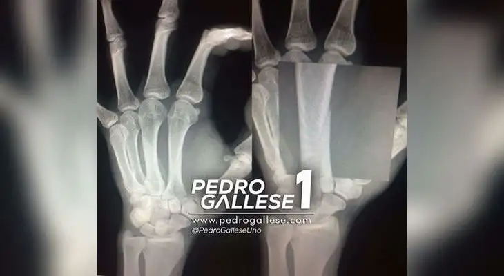 Esta es la radiografía que presentó Pedro Gallese para señalar la gravedad de su lesión. Esta es la radiografía que presentó Pedro Gallese para señalar la gravedad de su lesión.