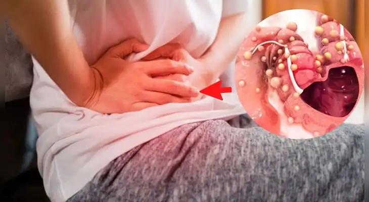 Conoce todo sobre el cáncer al colon Conoce todo sobre el cáncer al colon
