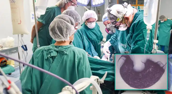 Operan de emergencia a niña con obstrucción en el estómago por masa de pelos. Operan de emergencia a niña con obstrucción en el estómago por masa de pelos.