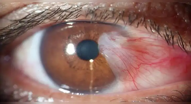 Cuidado con las cataratas en los ojos.