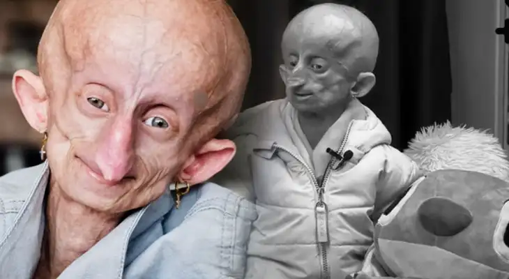 Fallece famosa tiktoker de 19 años tras padecer de rara enfermedad que ocasiona envejecimiento. Fallece famosa tiktoker de 19 años tras padecer de rara enfermedad que ocasiona envejecimiento.